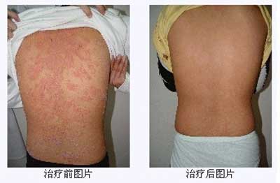 皮屑症状01.jpg